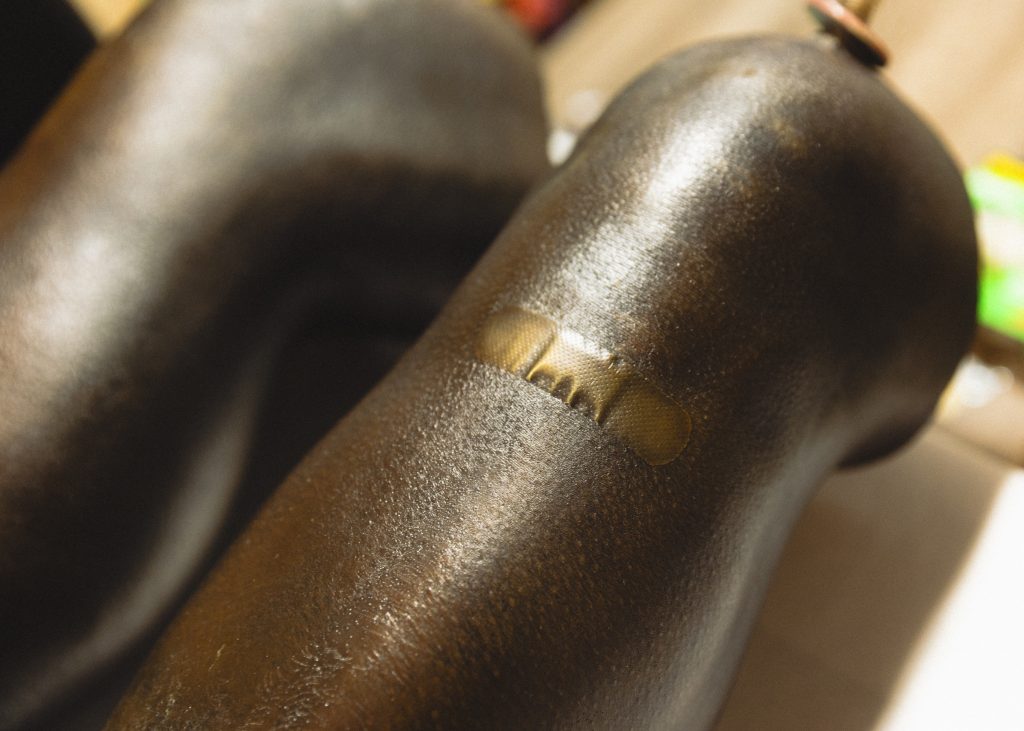 Image: A close-up detail of a hyper-realistic bronze sculpture of a pair of disembodied human knees with a bandage. Photo by Asa Featherstone, IV.